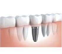 Best Dental Implants in Indore Dr Atul Jajoo